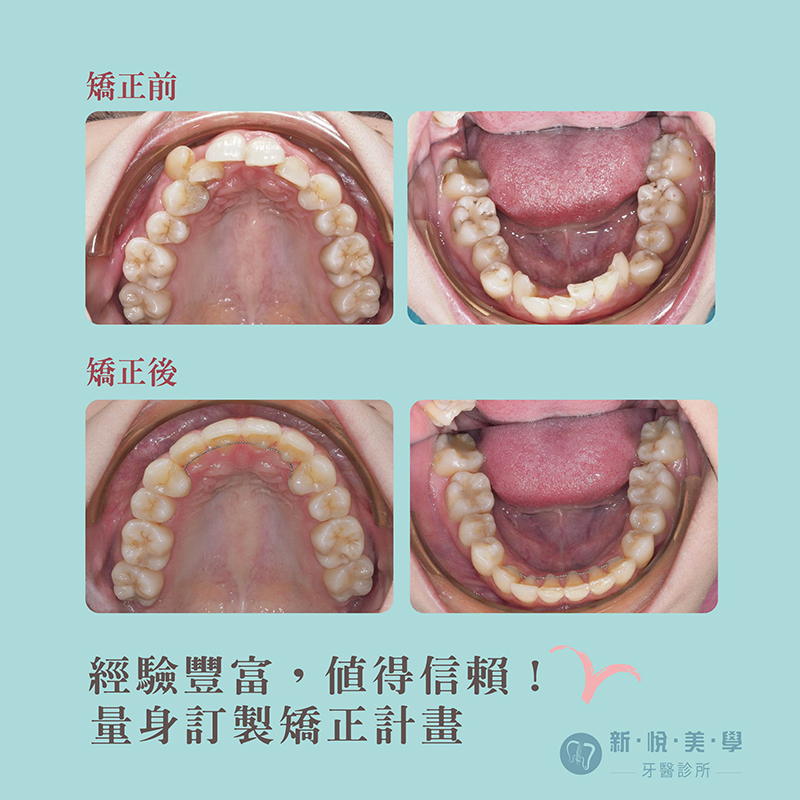 牙齒亂糟糟 ! 困難案例 !新悅不放棄的第2張圖片